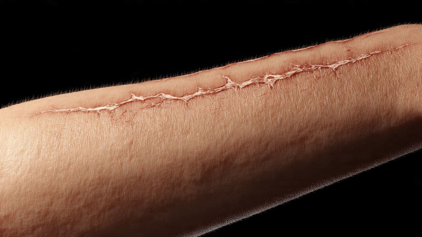Herida en un brazo