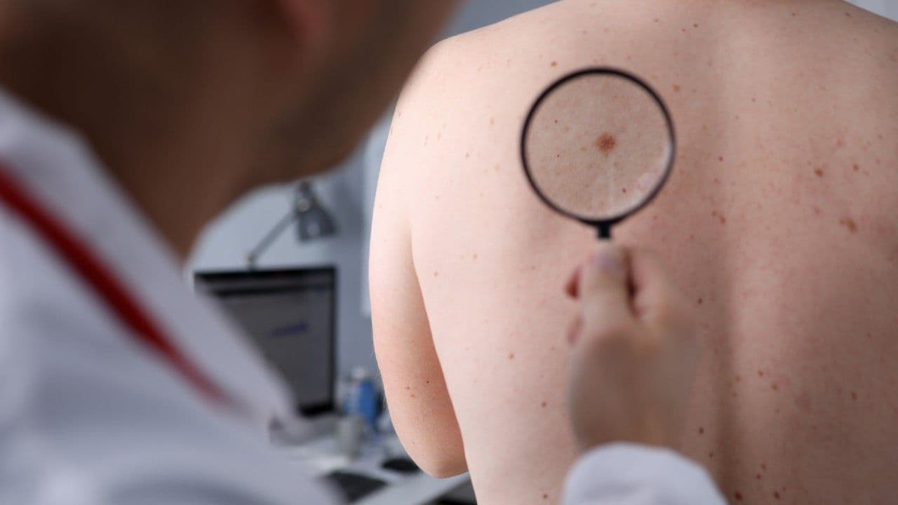 photologuephotos2025-04melanomajpg