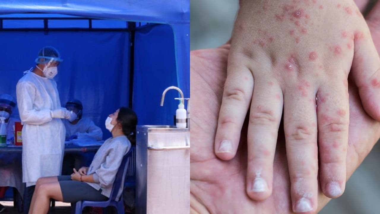 Brote de virus Coxsackie