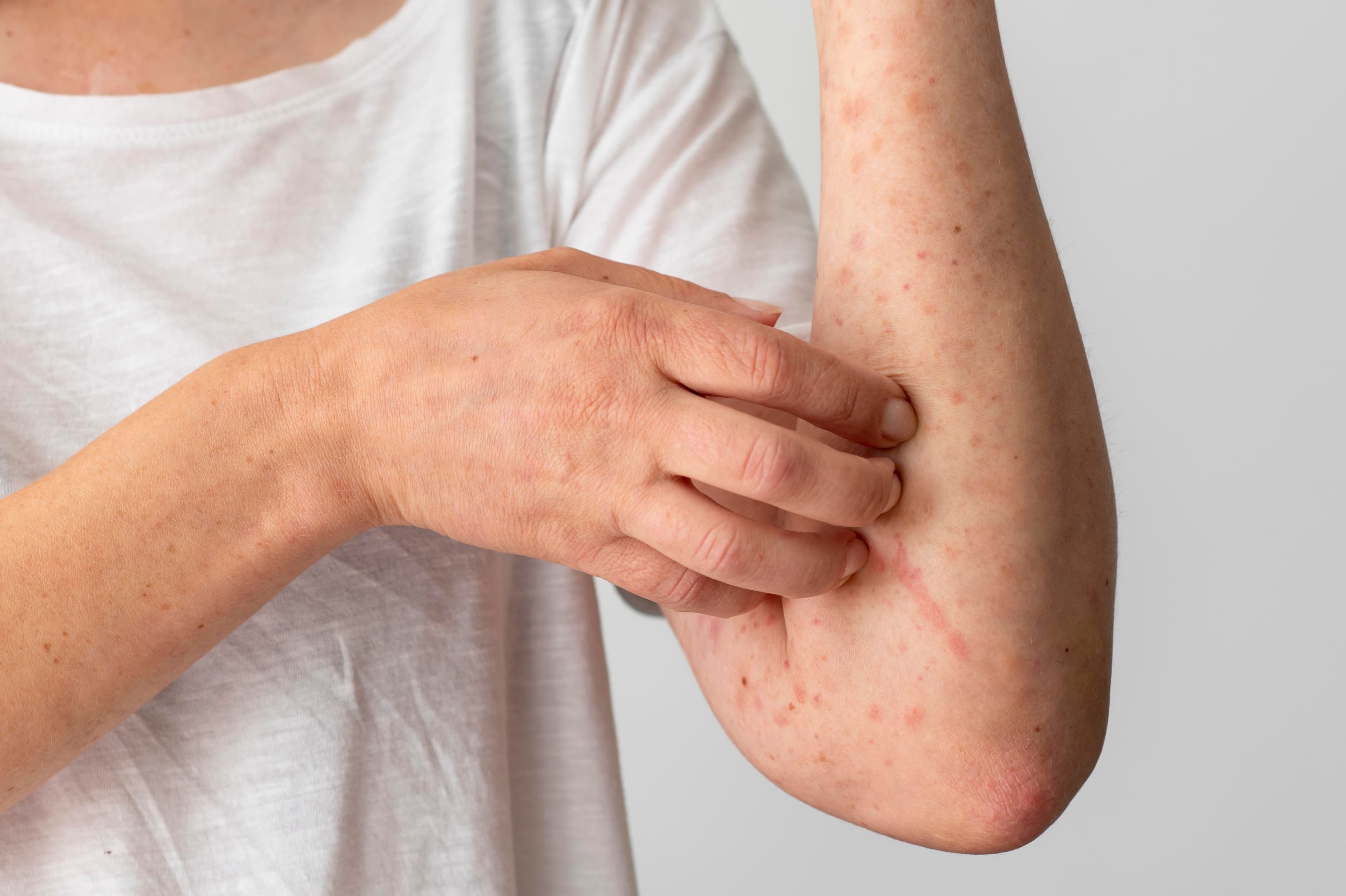 photologuephotos2022-11skin-allergy-reaction-on-person-s-armjpg