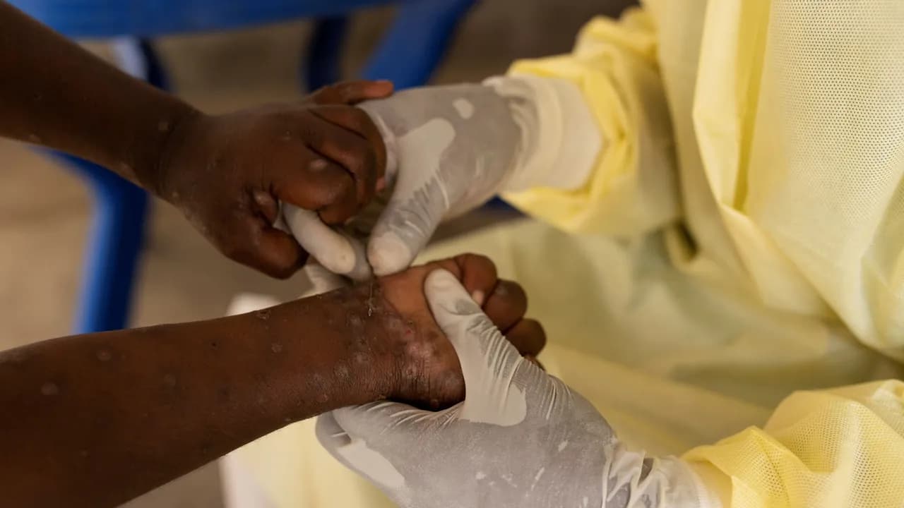 photologuephotos2024-082024-07-24t083648z_1349186653_rc2yx8alilp0_rtrmadp_3_health-mpox-congojpg photologuephotos2024-082024-07-24t083648z_1349186653_rc2yx8alilp0_rtrmadp_3_health-mpox-congojpg