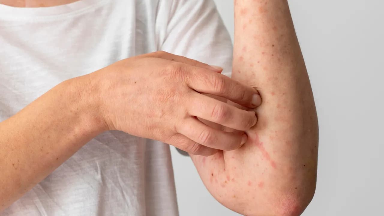 photologuephotos2022-11skin-allergy-reaction-on-person-s-armjpg photologuephotos2022-11skin-allergy-reaction-on-person-s-armjpg