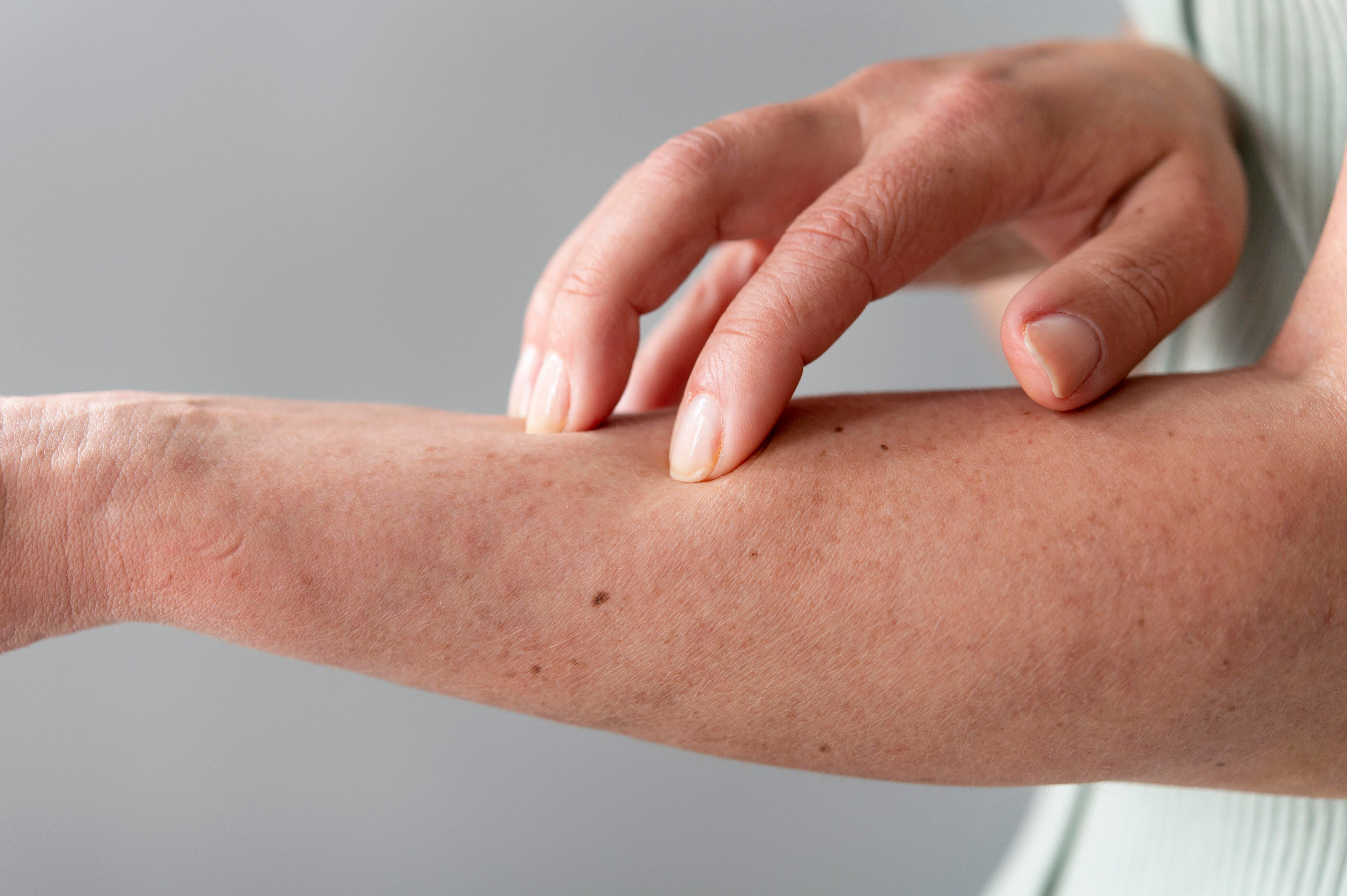 alergia-cutanea-brazo-persona.jpg