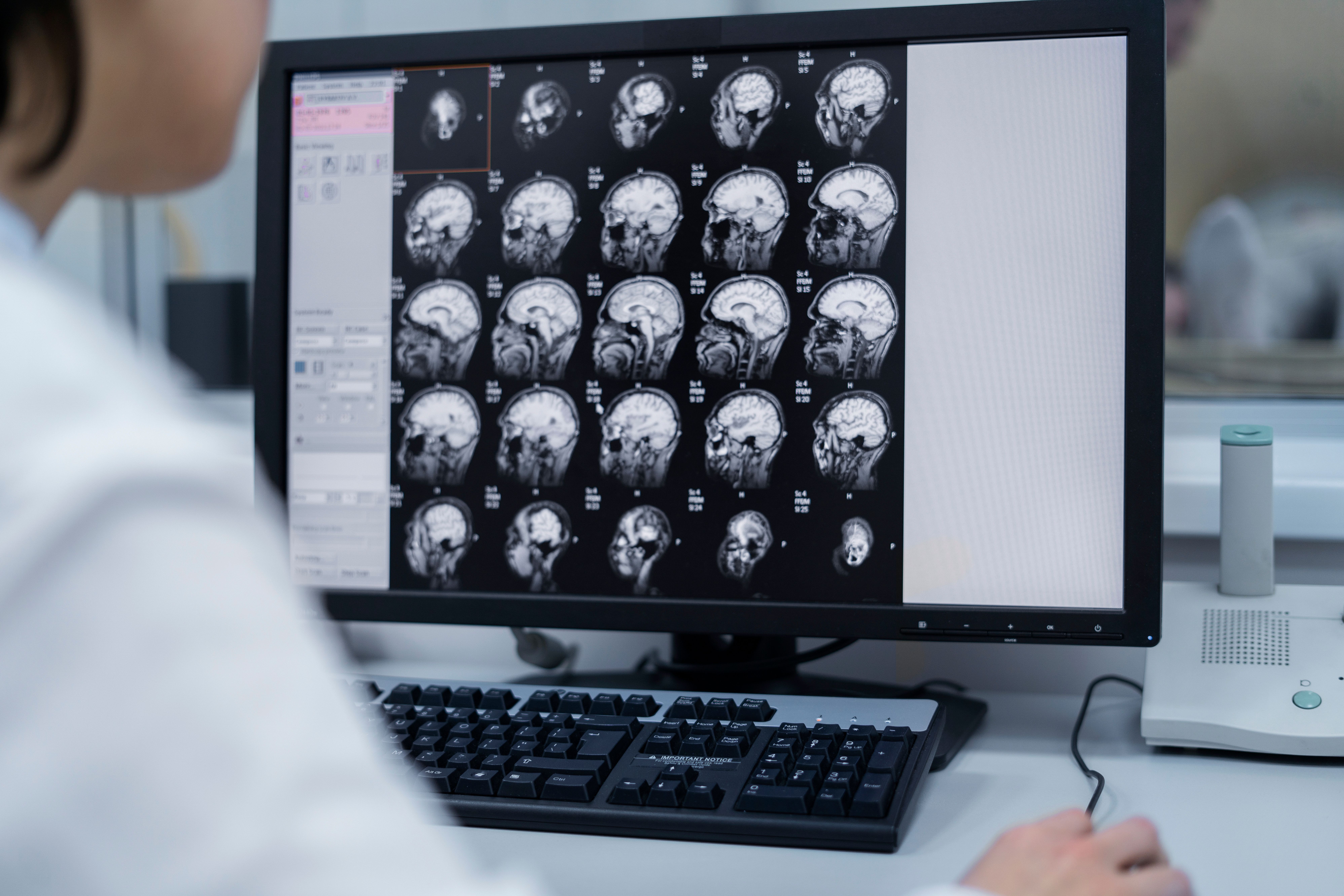 La ELA es 1una enfermedad que degenera las neuronas motoras en el cerebro y la médula espinal. Créditos: Freepik