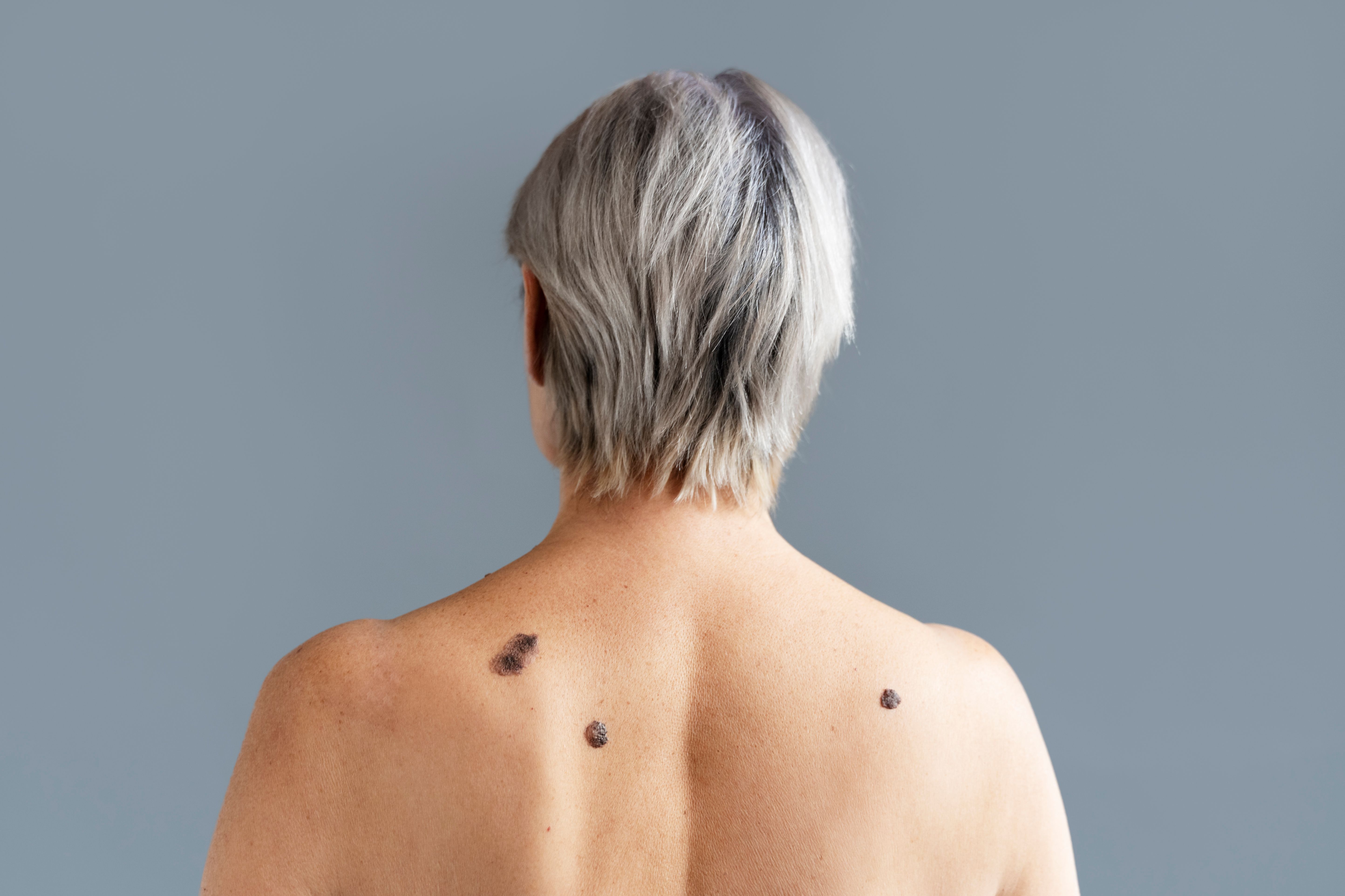 back-view-senior-woman-with-melanoma.jpg