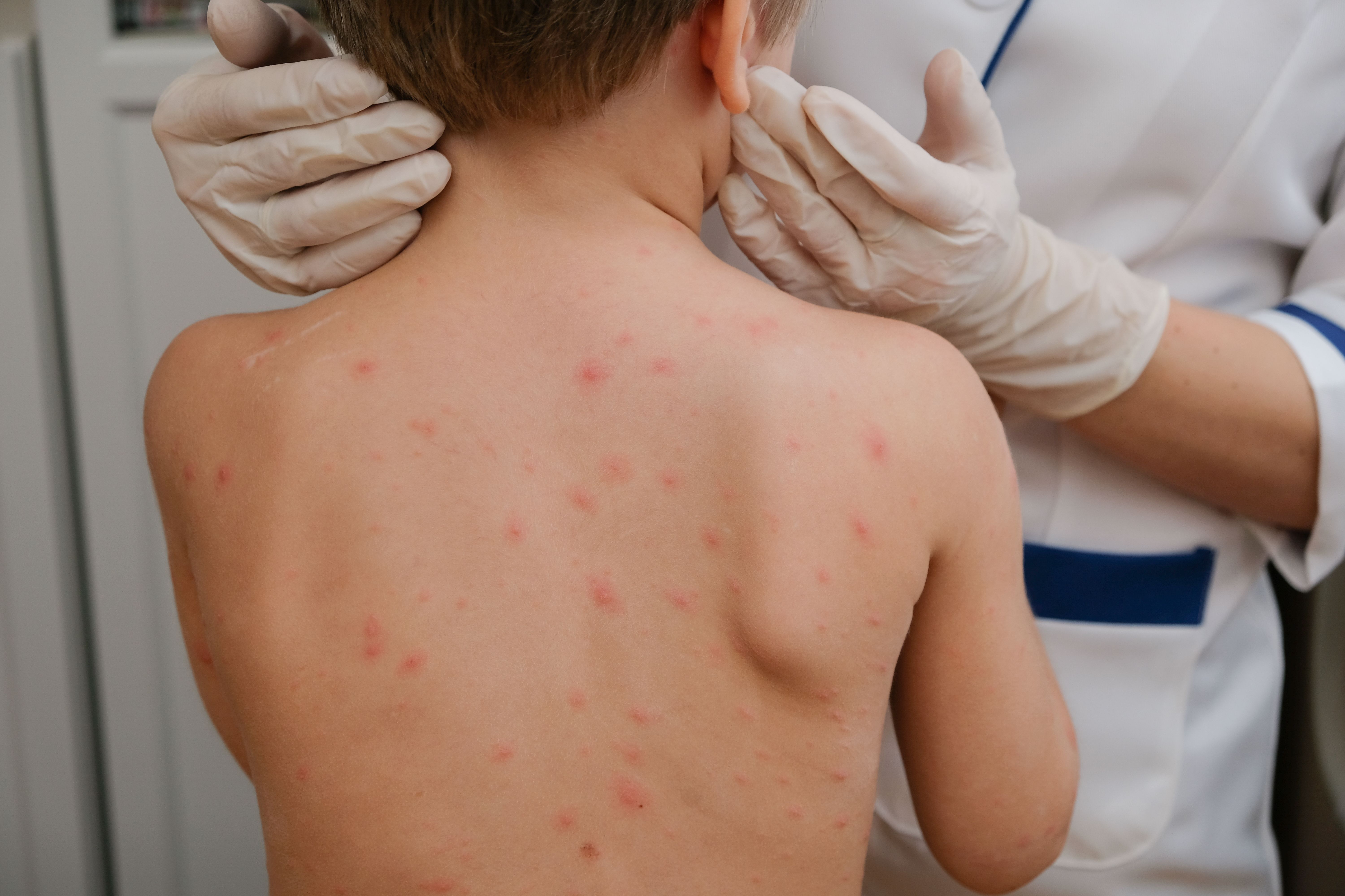 doctor-applying-cream-baby-s-skin-with-blisters-rash-caused-by-chickenpox.jpg
