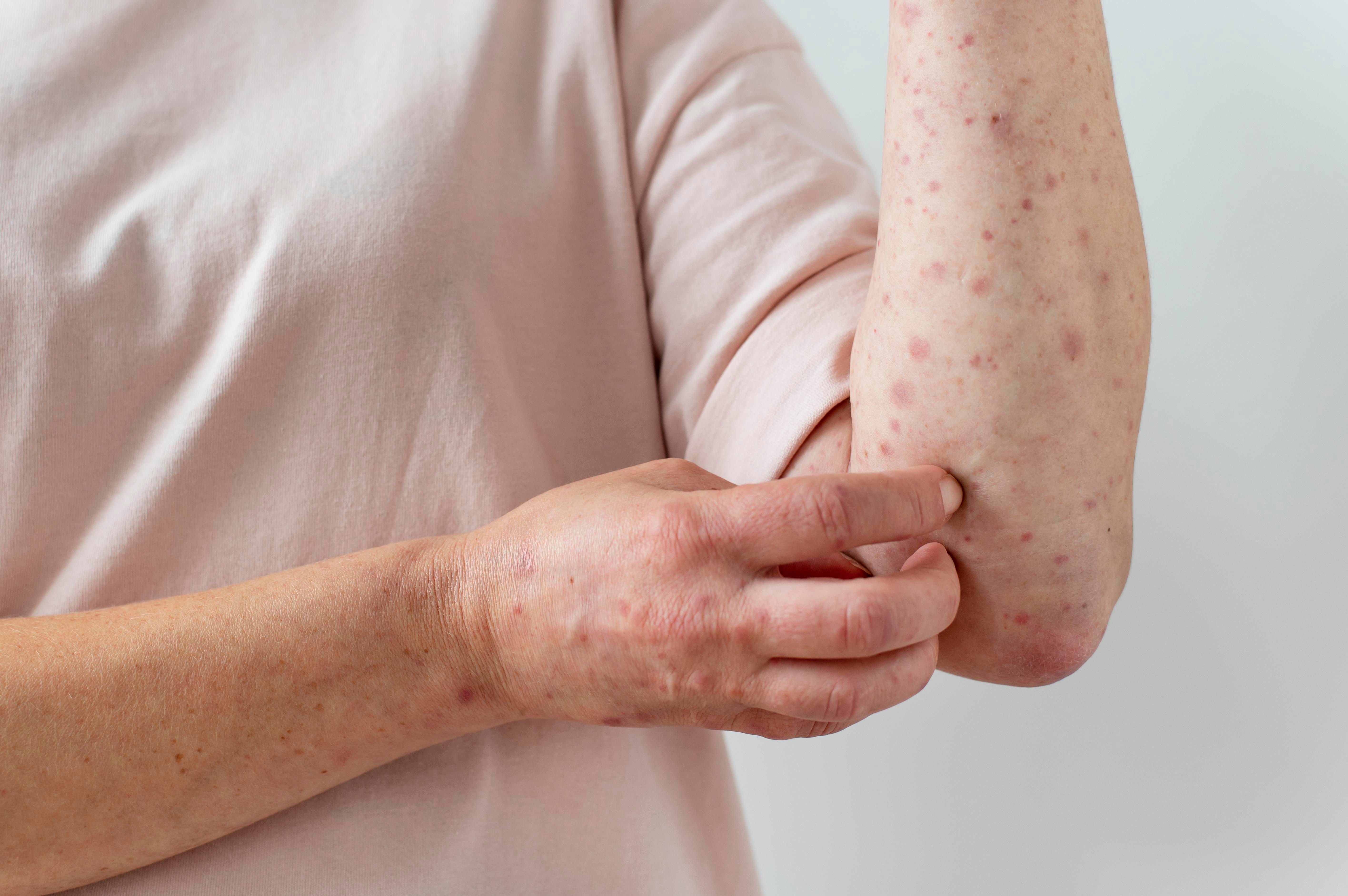 skin-allergy-person-s-arm (2).jpg