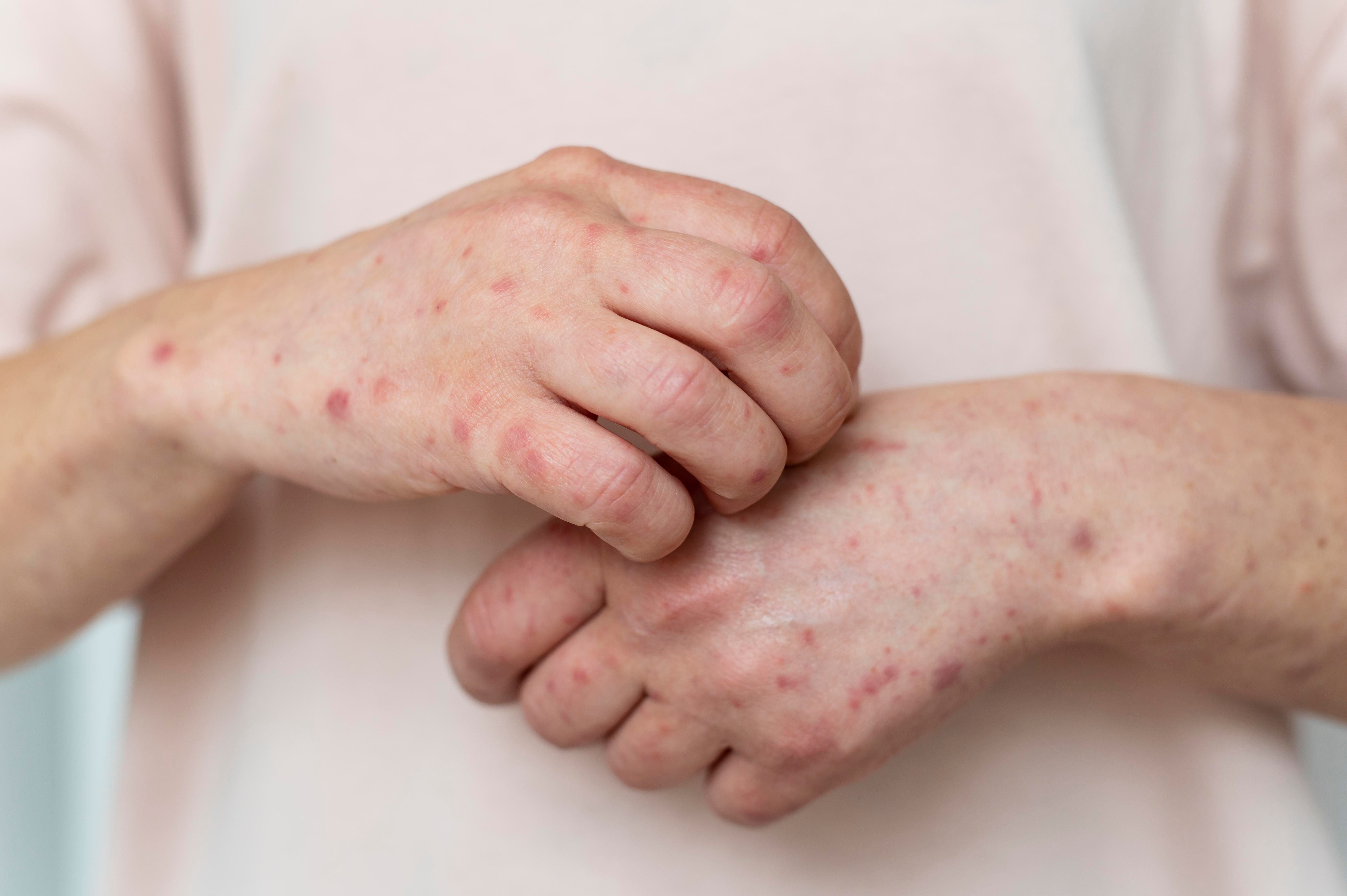 skin-allergy-person-s-arm.jpg