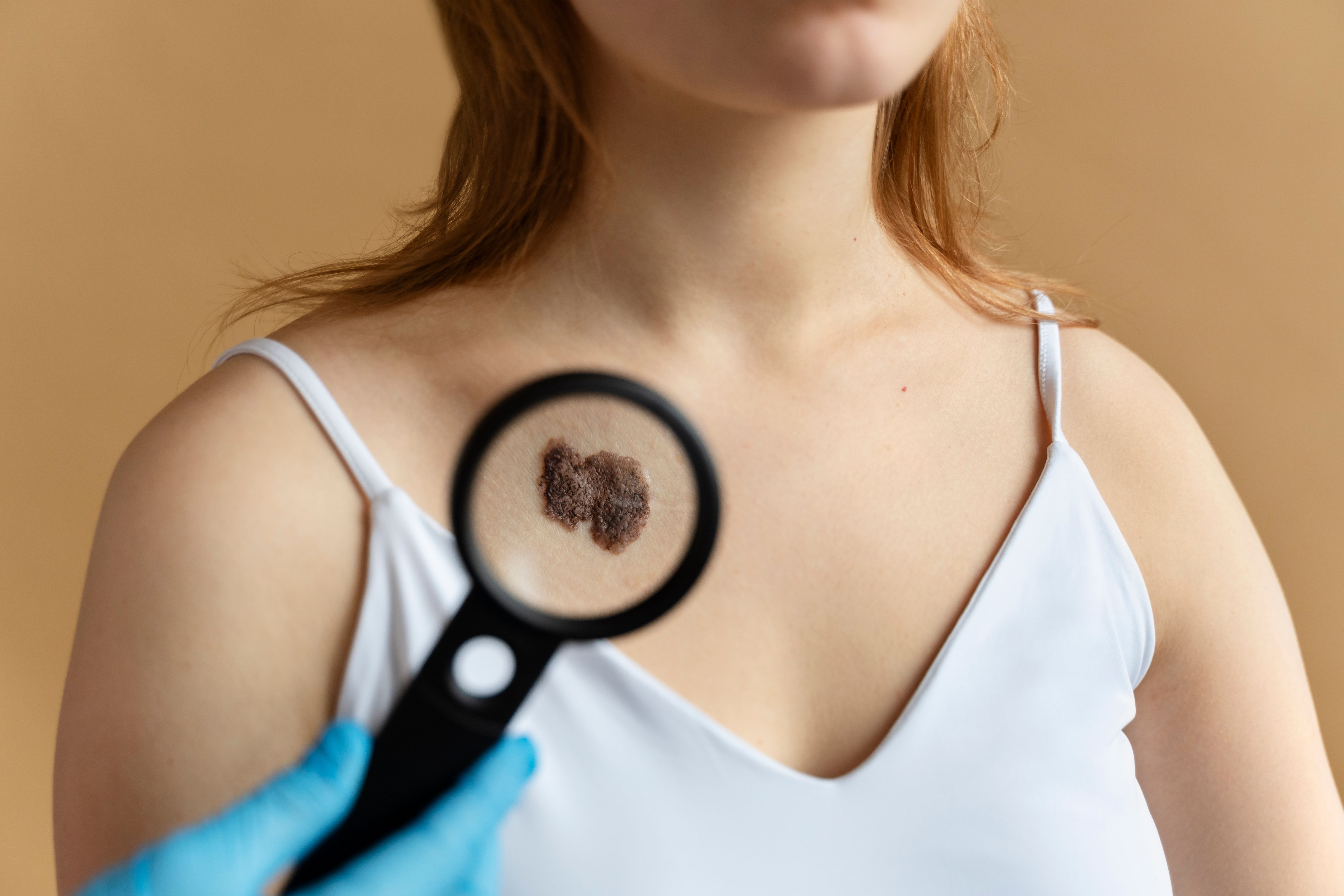 young-woman-with-big-mole-chest.jpg